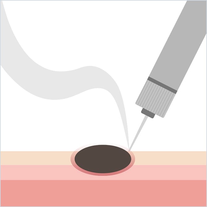 電気メスでほくろを焼くイラスト
