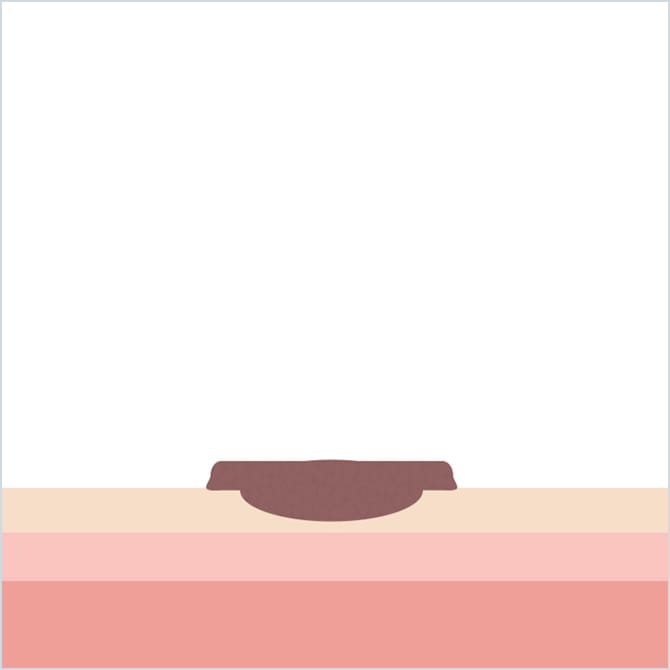 ほくろ除去後1週間~10日後のイラスト