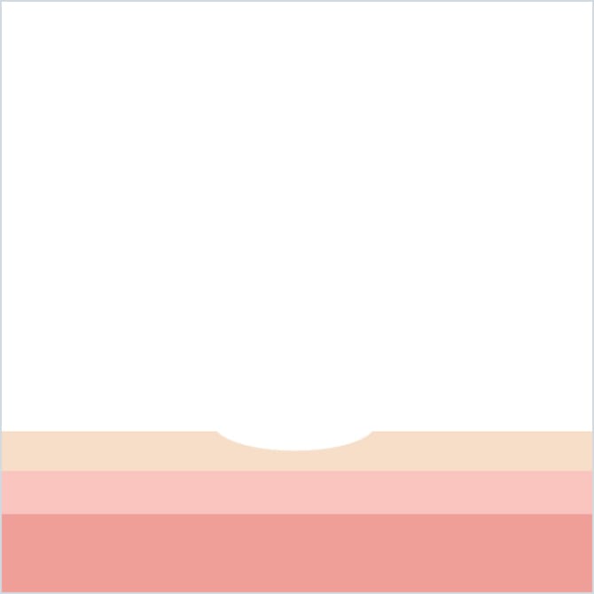 ほくろ除去後のイラスト