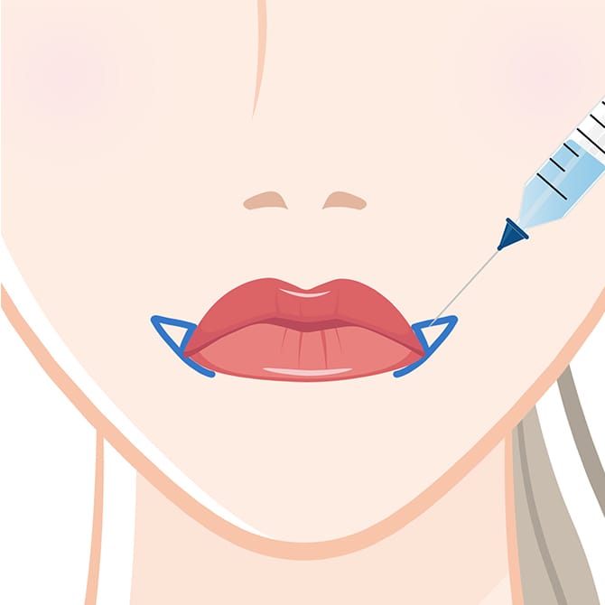 口に麻酔する図