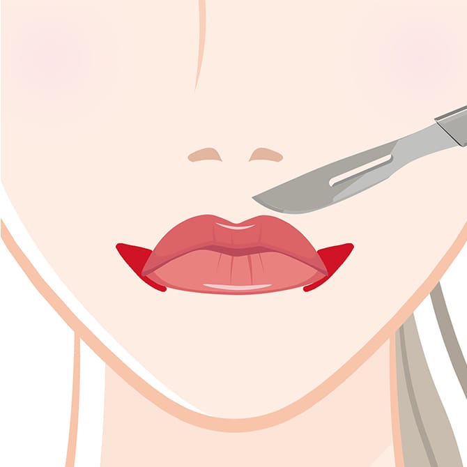 口角の皮膚の切除の図