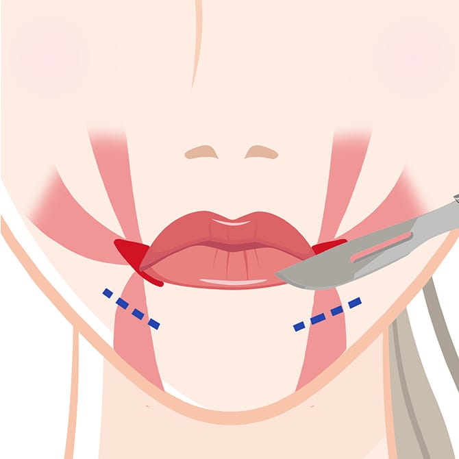 口角下制筋切除の図