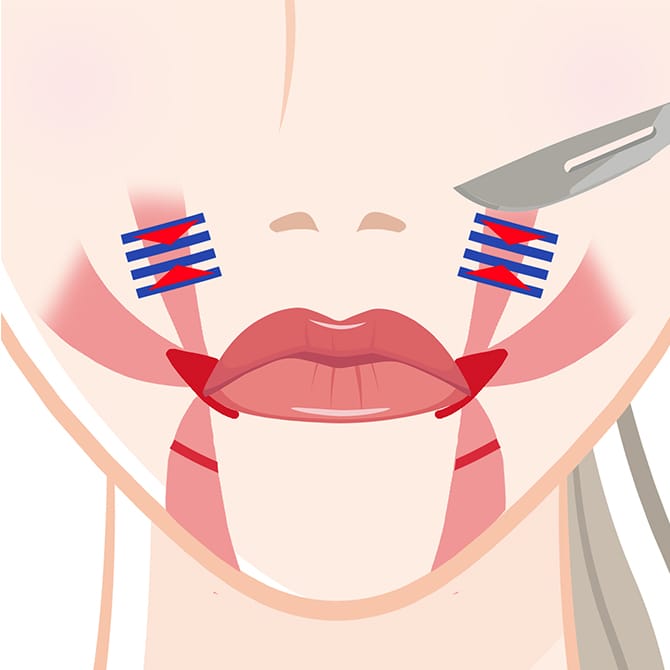 口角挙筋短縮の図