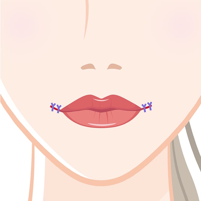 口角の切開部位の縫合の図