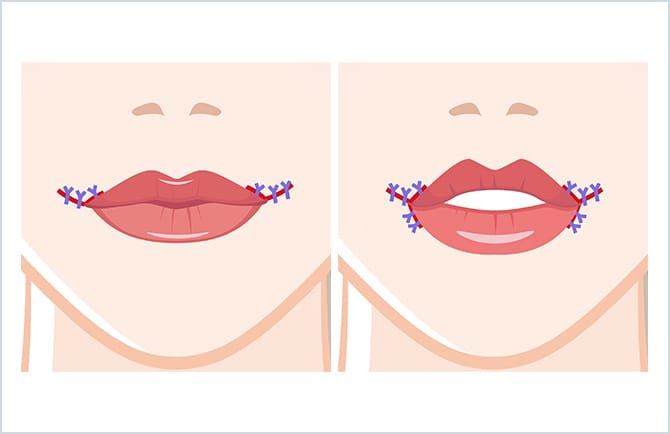 口角の切開部位の縫合の図