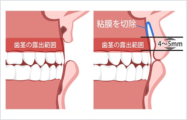上口腔粘膜の切除時の口の断面図