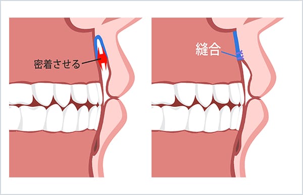 上口腔粘膜の縫合時の口の断面図
