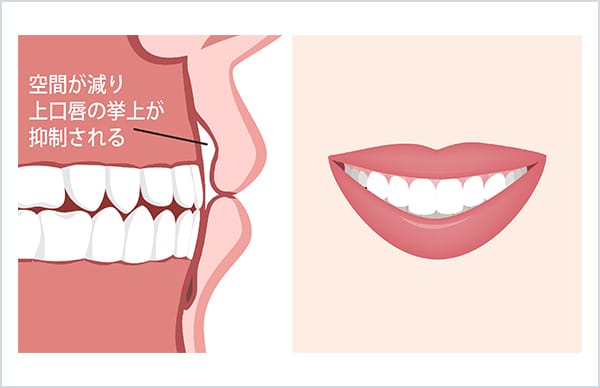 上唇内側切除し術後の口のイラスト