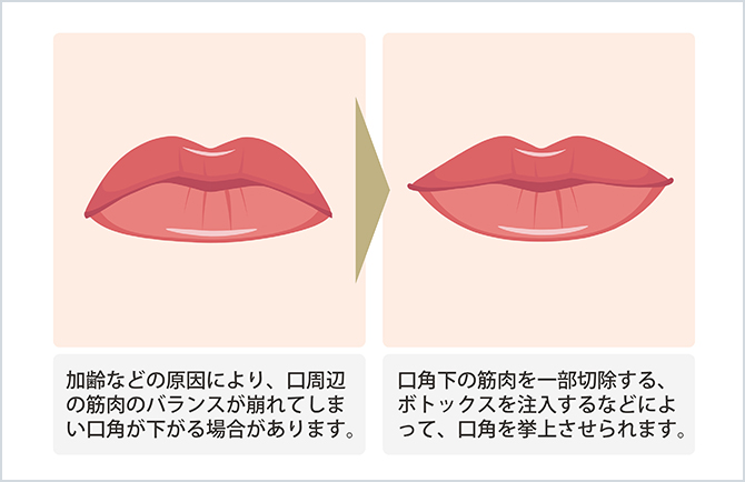 ヒアルロン酸注入による唇の変化のイラスト