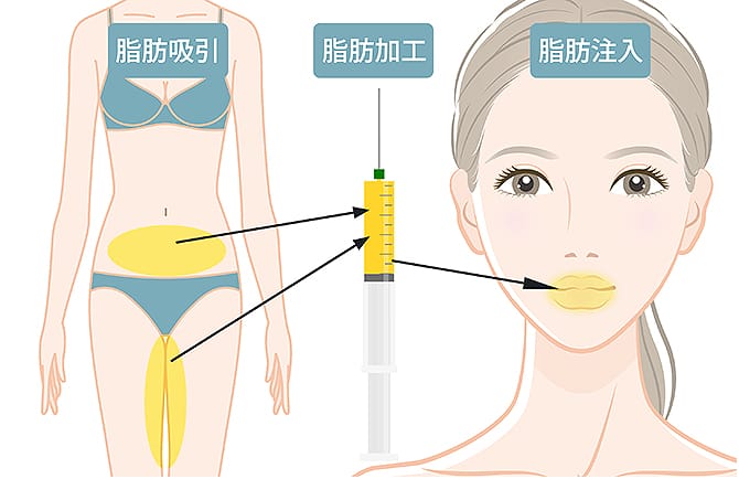 お腹・太ももの脂肪を吸引して加工し、唇の脂肪注入に使用する図