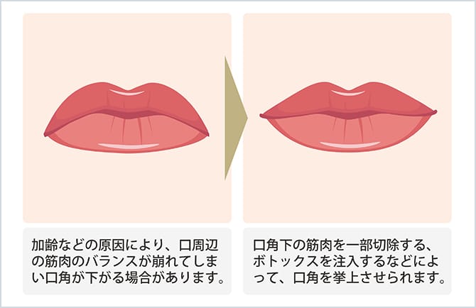 口角挙上術のイラスト