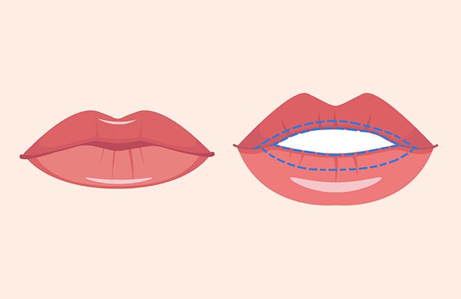 唇の切開部にマーキングする図
