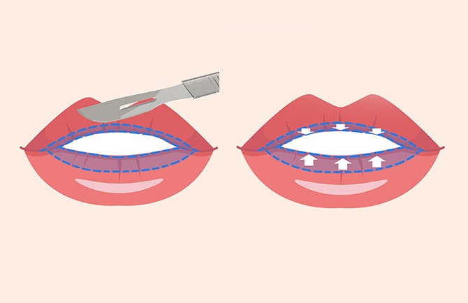 唇の粘膜を切開するイラスト