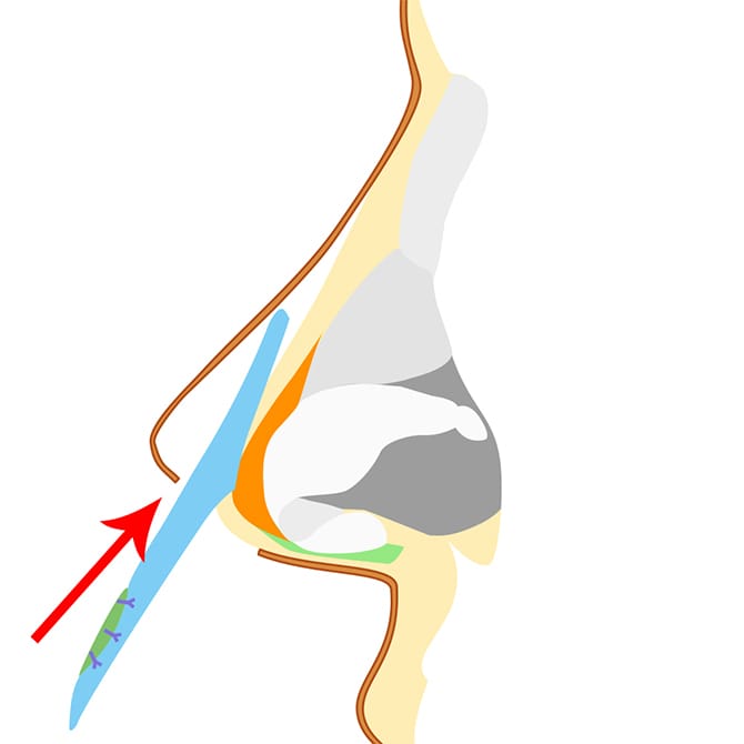 軟骨などの自家組織の挿入