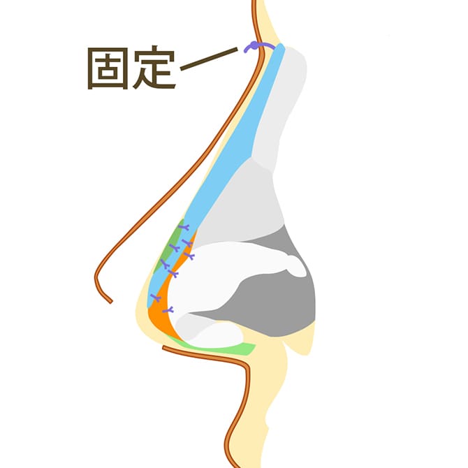 挿入した組織を軟骨などに固定する図