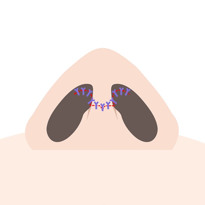 鼻の縫合イメージ