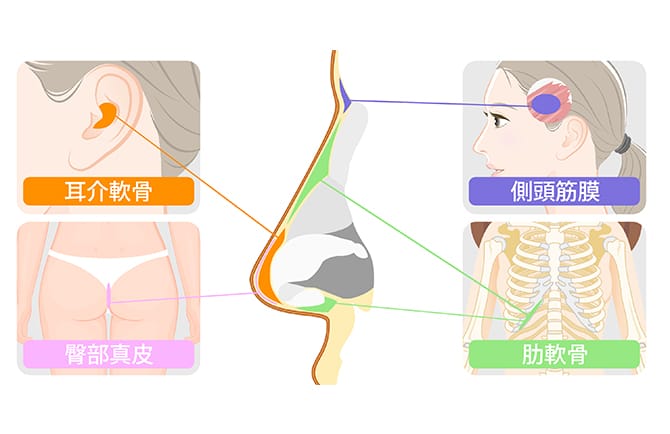 耳介軟骨、臀部真皮、側頭筋膜、肋軟骨
