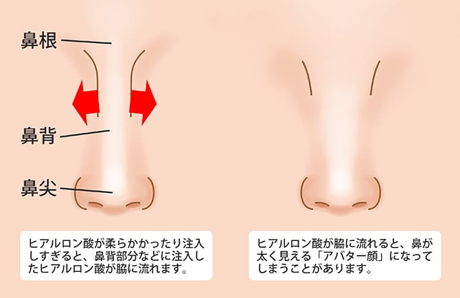 鼻ヒアルロン酸注入隆鼻術 鼻の整形ならジョウクリニック