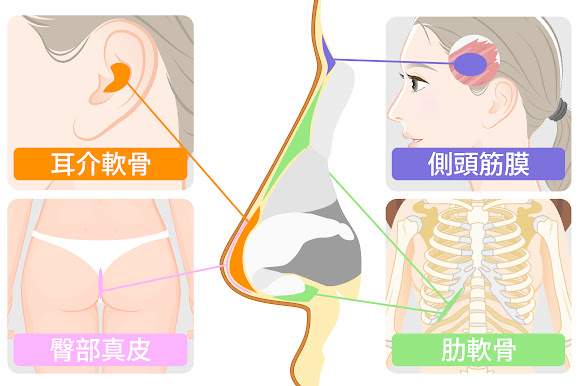自家組織移植術