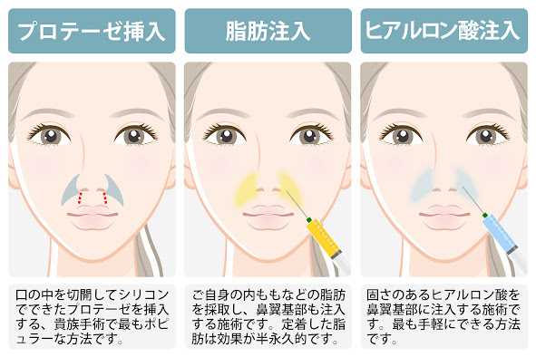 貴族手術(鼻翼基部形成術)