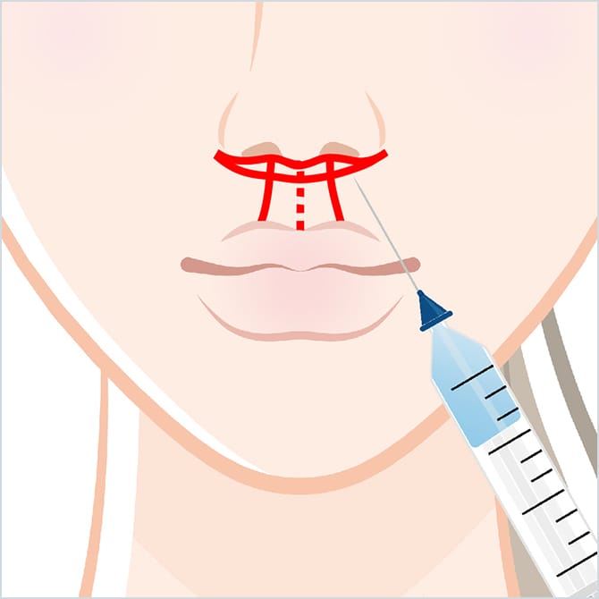 人中に麻酔する図