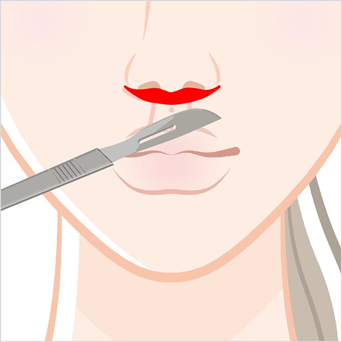 鼻下の皮膚の切除イメージ