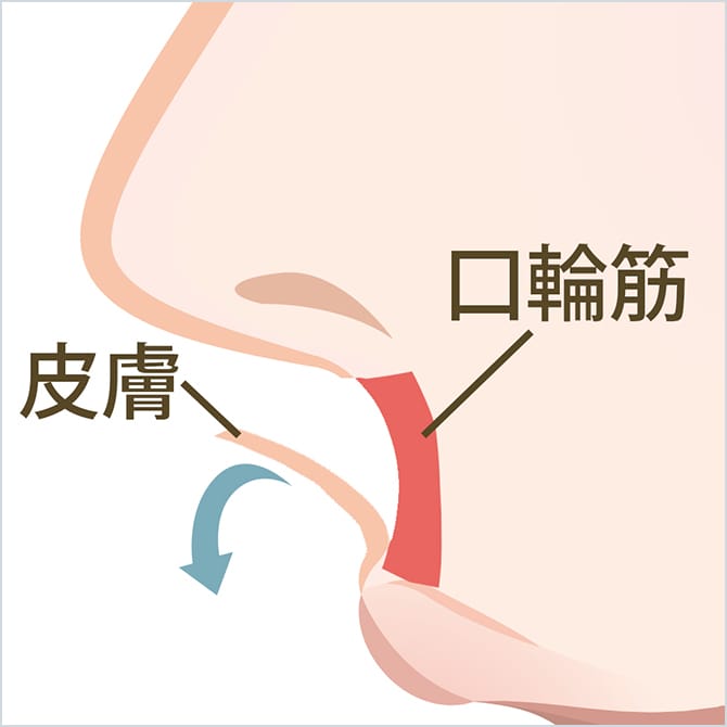 創縁から皮下を剥がし、口輪筋を表出するイメージ