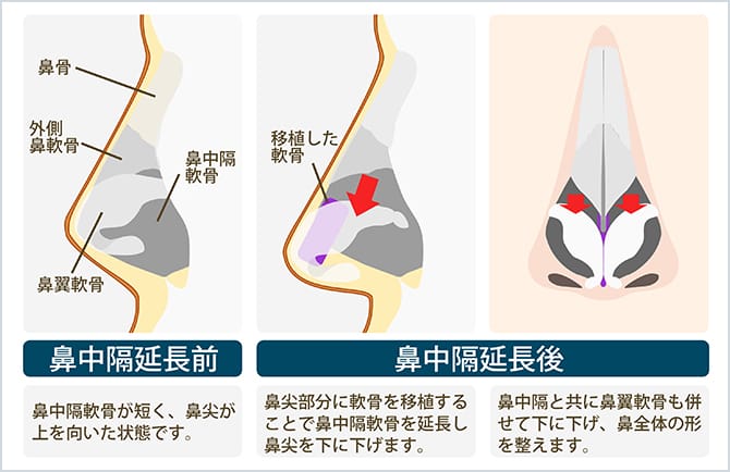 鼻の支柱である鼻中隔軟骨