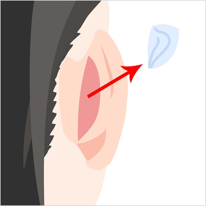 自家組織(耳介軟骨)を採取