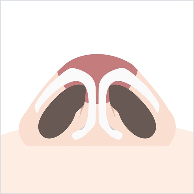 鼻翼軟骨を露出