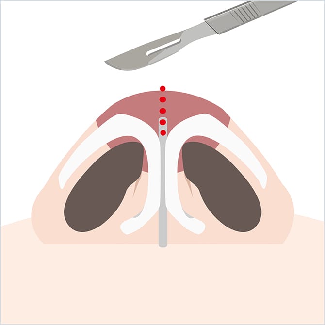 鼻中隔軟骨を露出