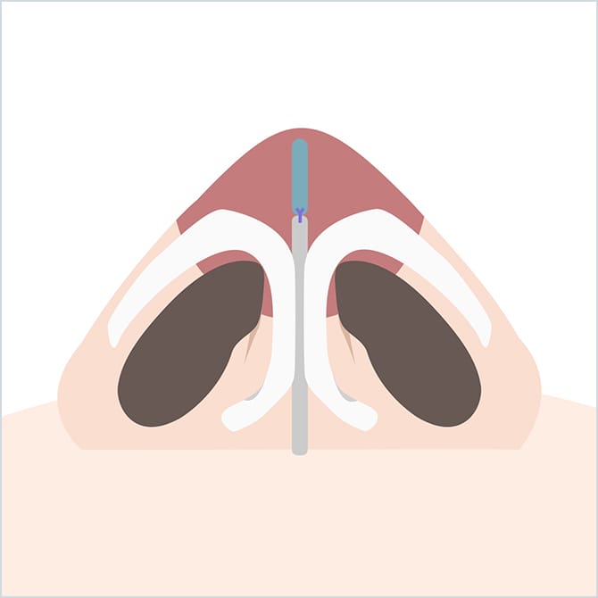 自家組織を移植