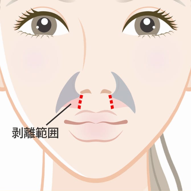 骨と皮下組織の間の剥離範囲の図