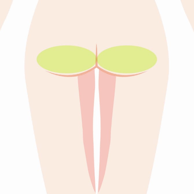 臀部の採脂位置イメージ