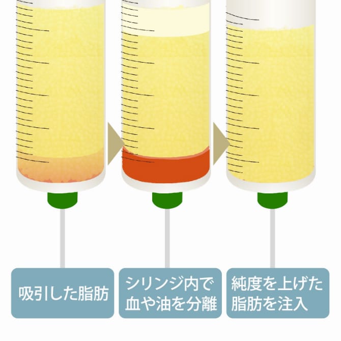 吸引した脂肪 シリンジ内で血や油を分離 純度を上げた脂肪を注入