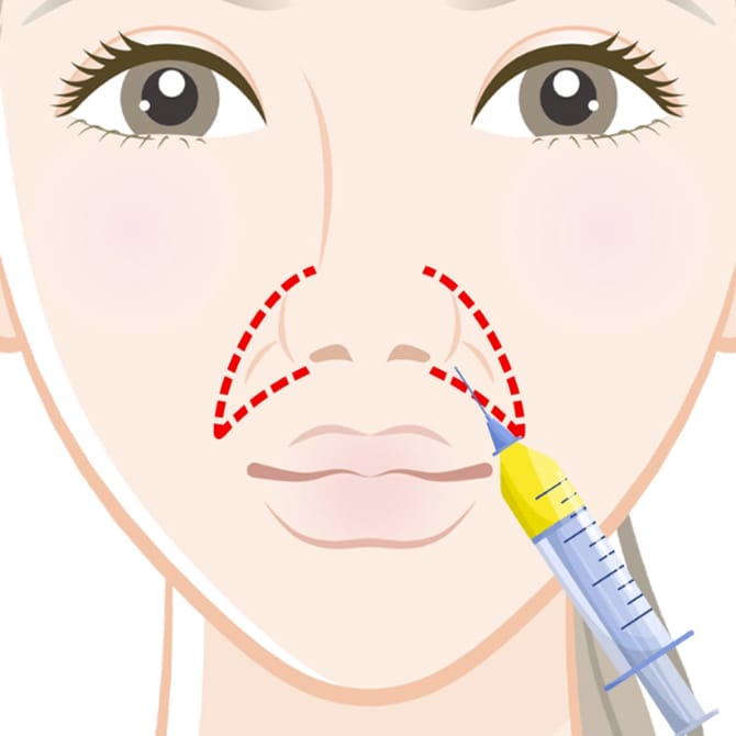 鼻翼基部に脂肪を注入するイメージ