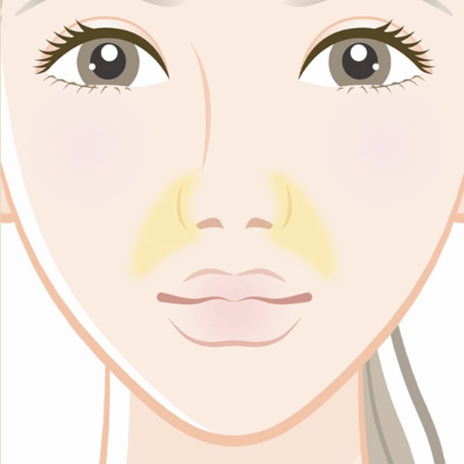 鼻翼基部自己脂肪注入術の施術完了