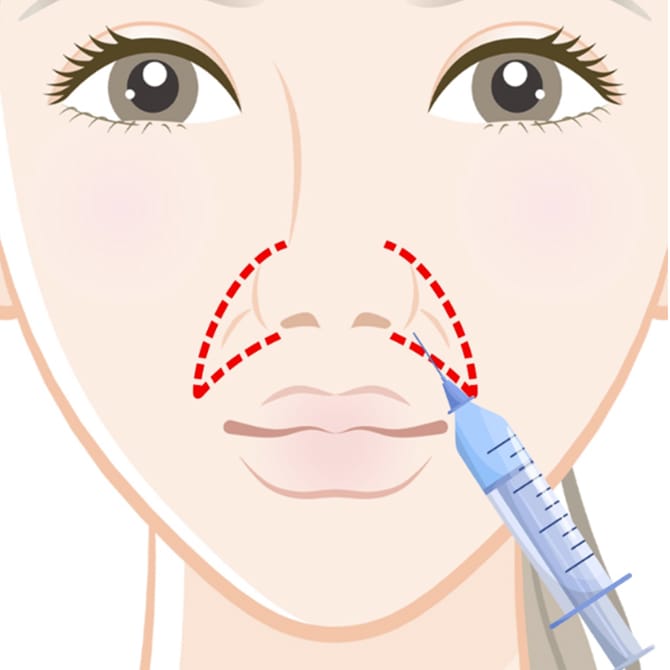 ヒアルロン酸注入イメージ
