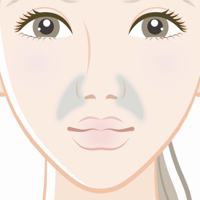 鼻翼基部ヒアルロン酸注入術の施術完了