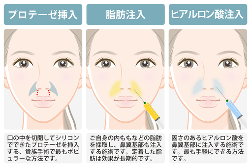 プロテーゼ挿入・自己脂肪注入・ヒアルロン酸注入