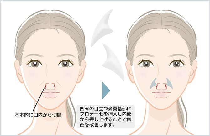 鼻翼基部プロテーゼ挿入術