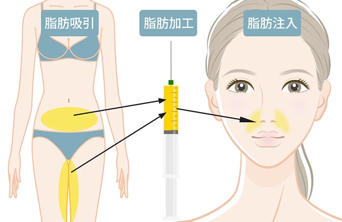 太腿や腹部の脂肪を加工して鼻翼に注入するイメージ