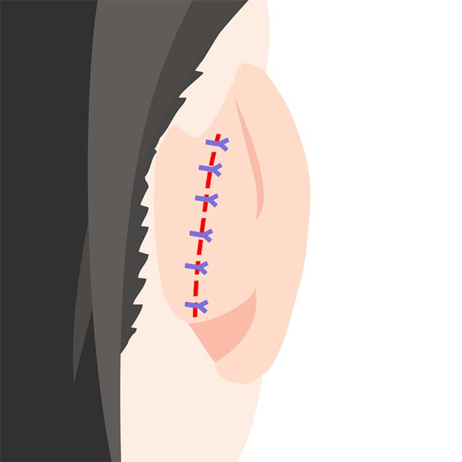 耳の縫合