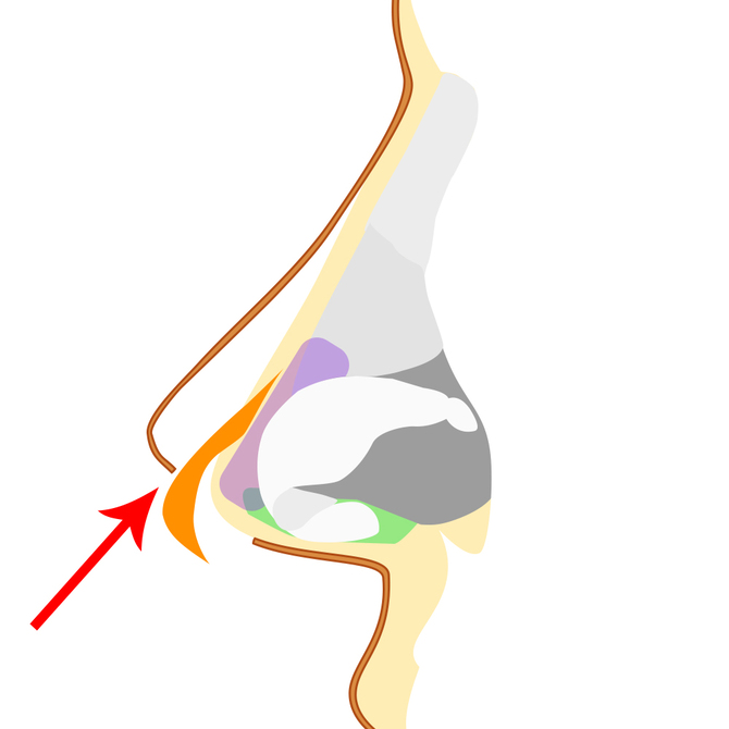 自家組織の挿入