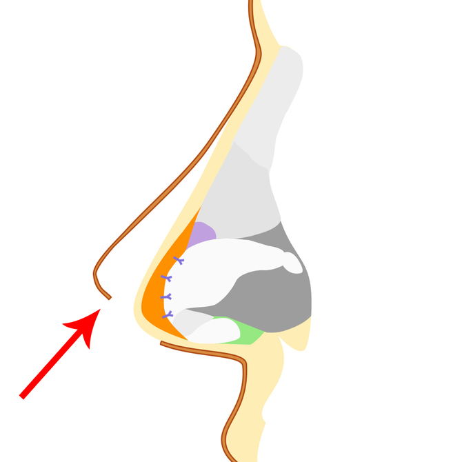 挿入した組織の固定