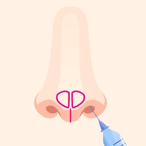 鼻に局所麻酔する