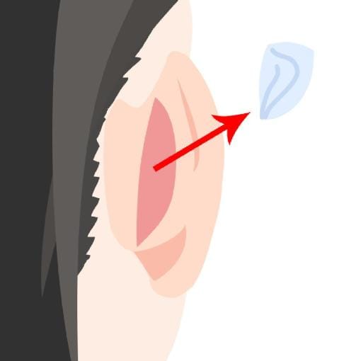 耳介軟骨の採取