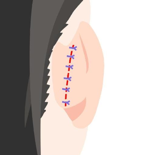 耳の縫合