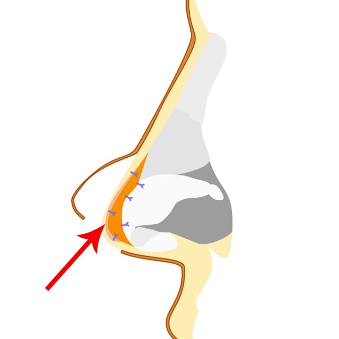 鼻尖への自家組織の挿入