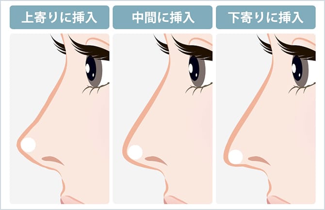 上寄りに挿入、中間に挿入、下よりに挿入した場合の図